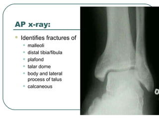 AP x-ray: 
 Identifies fractures of 
• malleoli 
• distal tibia/fibula 
• plafond 
• talar dome 
• body and lateral 
process of talus 
• calcaneous 
 