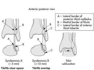 Tib/fib clear space Tib /fib overlap 
 