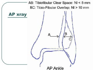 AP xray 
 