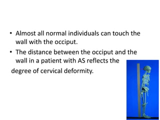 • Almost all normal individuals can touch the
wall with the occiput.
• The distance between the occiput and the
wall in a patient with AS reflects the
degree of cervical deformity.
 