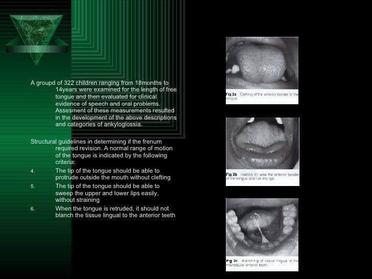 Ankyloglossia (Tonguetie)