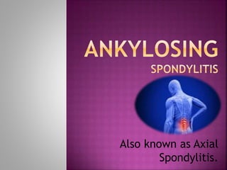 Also known as Axial
Spondylitis.
 