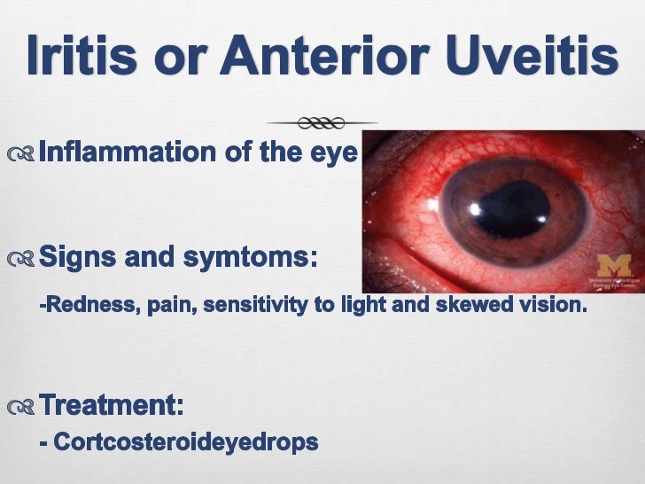 Ankylosing spondylitis