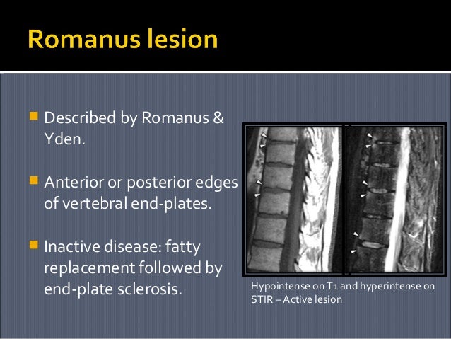 Ankylosing spondylitis