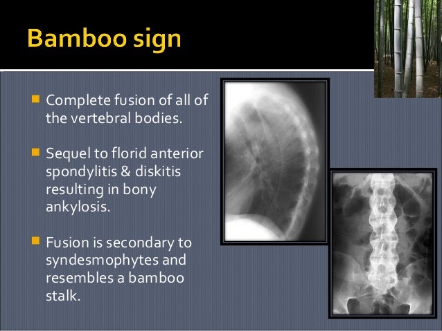 Ankylosing spondylitis