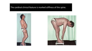 The cardinal clinical feature is marked stiffness of the spine.
 