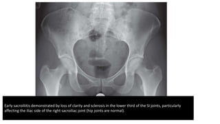 Early sacroiliitis demonstrated by loss of clarity and sclerosis in the lower third of the SI joints, particularly
affecting the iliac side of the right sacroiliac joint (hip joints are normal).
 