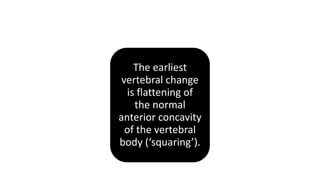 The earliest
vertebral change
is flattening of
the normal
anterior concavity
of the vertebral
body (‘squaring’).
 