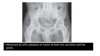 • Advanced AS with ankylosis or fusion of both the sacroiliac and hip
joints.
 