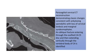 Parasagittal cervical CT
reconstruction
demonstrating classic changes
consistent with ankylosing
spondylitis with loss of cervical
lordosis and marginal
syndesmophytes.
An oblique fracture entering
through the ossified C4-C5
disc and then extending
vertically through the
vertebral body of C4 is
identified
 