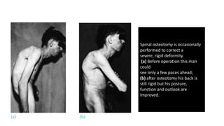 Spinal osteotomy is occasionally
performed to correct a
severe, rigid deformity.
(a) Before operation this man
could
see only a few paces ahead;
(b) after osteotomy his back is
still rigid but his posture,
function and outlook are
improved.
 