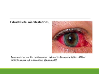 Extraskeletal manifestations:
Acute anterior uveitis: most common extra articular manifestation. 40% of
patients. can result in secondary glaucoma (6)
 