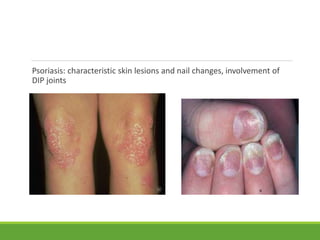 Psoriasis: characteristic skin lesions and nail changes, involvement of
DIP joints
 