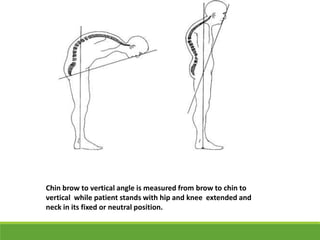 Chin brow to vertical angle is measured from brow to chin to
vertical while patient stands with hip and knee extended and
neck in its fixed or neutral position.
 