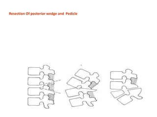 Resection Of posterior wedge and Pedicle
 