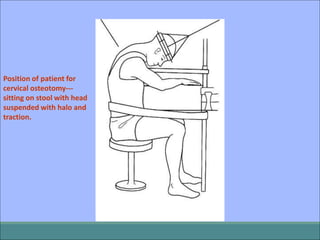 Position of patient for
cervical osteotomy---
sitting on stool with head
suspended with halo and
traction.
 
