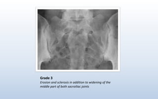 Grade 3
Erosion and sclerosis in addition to widening of the
middle part of both sacroiliac joints
 
