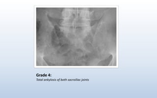 Grade 4:
Total ankylosis of both sacroiliac joints
 