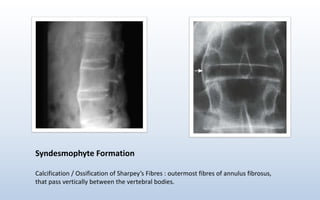 Syndesmophyte Formation
Calcification / Ossification of Sharpey’s Fibres : outermost fibres of annulus fibrosus,
that pass vertically between the vertebral bodies.
 
