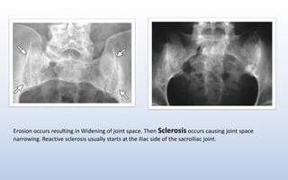 Erosion occurs resulting in Widening of joint space. Then Sclerosis occurs causing joint space
narrowing. Reactive sclerosis usually starts at the iliac side of the sacroiliac joint.
 