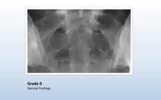 Grade 0
Normal Findings
 