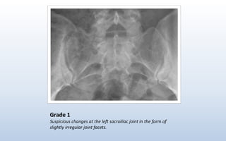 Grade 1
Suspicious changes at the left sacroiliac joint in the form of
slightly irregular joint facets.
 
