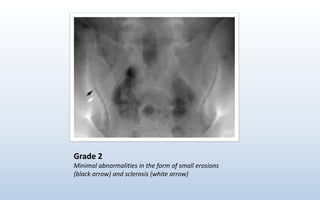 Grade 2
Minimal abnormalities in the form of small erosions
(black arrow) and sclerosis (white arrow)
 