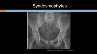 Syndesmophytes
12 December 2020Ratankhuman (M.P.T., Ortho & Sports)
15
 