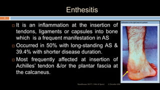 Enthesitis
 It is an inflammation at the insertion of
tendons, ligaments or capsules into bone
which is a frequent manifestation in AS
 Occurred in 50% with long-standing AS &
39.4% with shorter disease duration.
 Most frequently affected at insertion of
Achilles’ tendon &/or the plantar fascia at
the calcaneus.
12 December 2020Ratankhuman (M.P.T., Ortho & Sports)
18
 