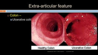 Extra-articular feature
 Colon –
 Ulcerative colitis
12 December 2020Ratankhuman (M.P.T., Ortho & Sports)
32
 