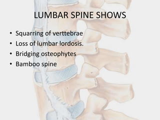 LUMBAR SPINE SHOWS
• Squarring of verttebrae
• Loss of lumbar lordosis.
• Bridging osteophytes
• Bamboo spine
 
