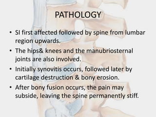 PATHOLOGY
• SI first affected followed by spine from lumbar
region upwards.
• The hips& knees and the manubriosternal
joints are also involved.
• Initially synovitis occurs, followed later by
cartilage destruction & bony erosion.
• After bony fusion occurs, the pain may
subside, leaving the spine permanently stiff.
 