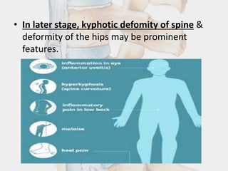 • In later stage, kyphotic defomity of spine &
deformity of the hips may be prominent
features.
 