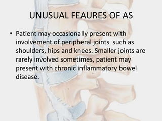 UNUSUAL FEAURES OF AS
• Patient may occasionally present with
involvement of peripheral joints such as
shoulders, hips and knees. Smaller joints are
rarely involved sometimes, patient may
present with chronic inflammatory bowel
disease.
 