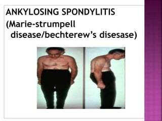 ANKYLOSING SPONDYLITIS
(Marie-strumpell
disease/bechterew’s disesase)
 