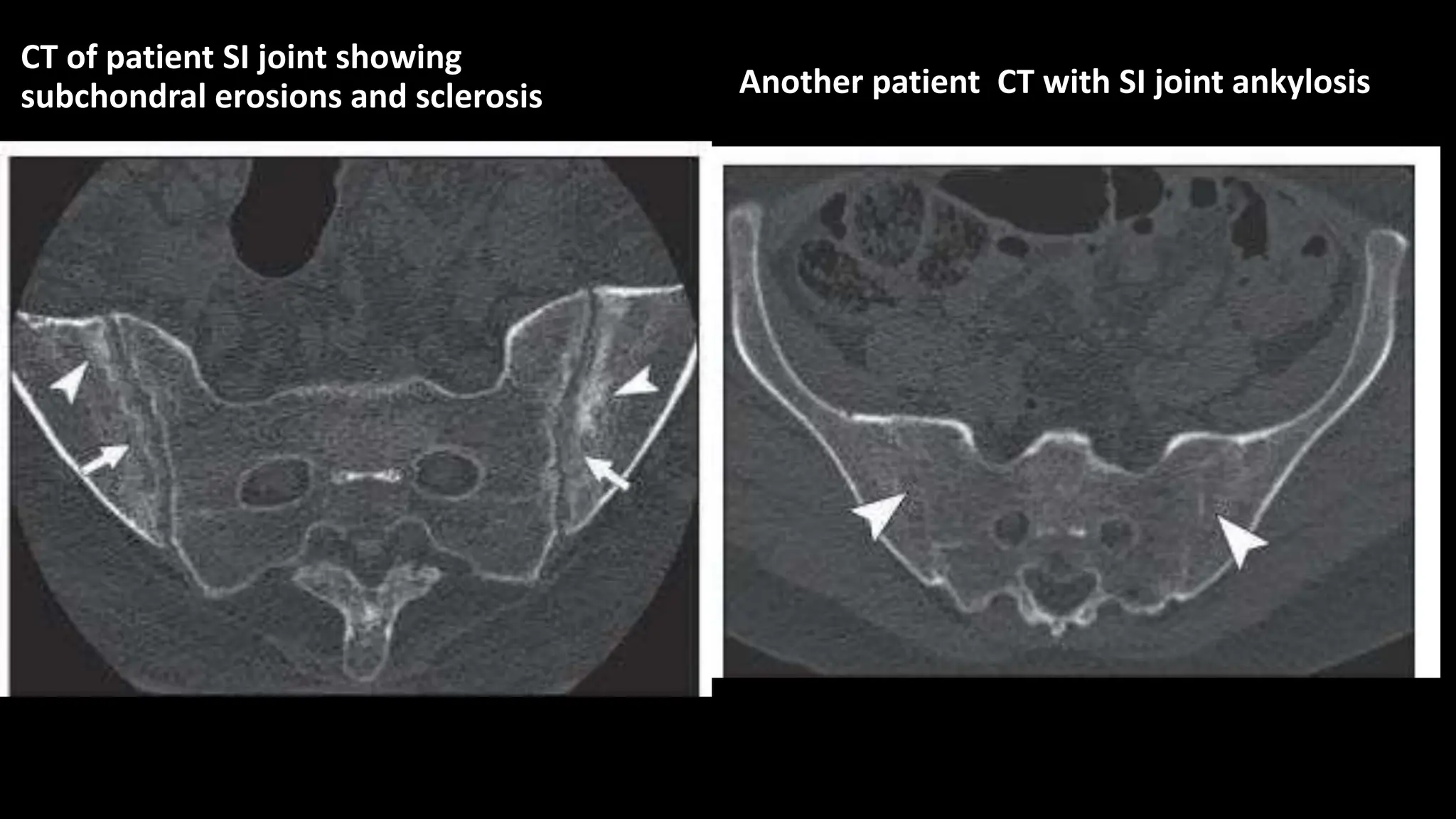 ANKYLOSING SPONDYLITIS RADIOLOGIC MANIFESTATIONS.pptx