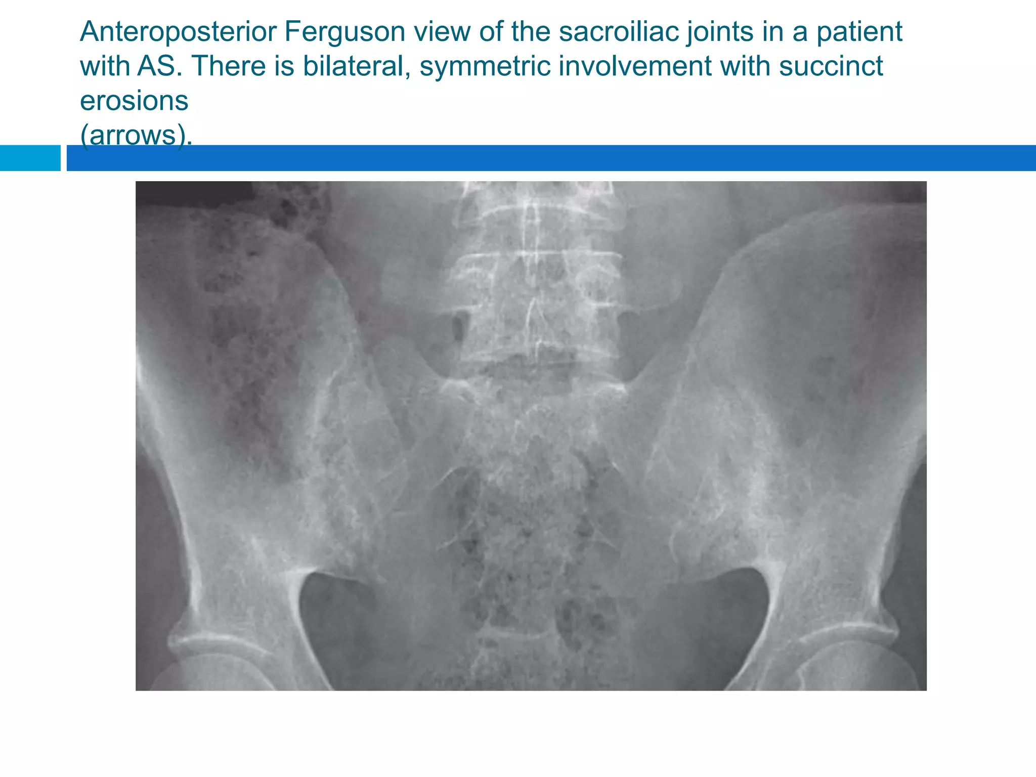 Ankylosing spondylitis clinical feature and diagnosis | PPTX