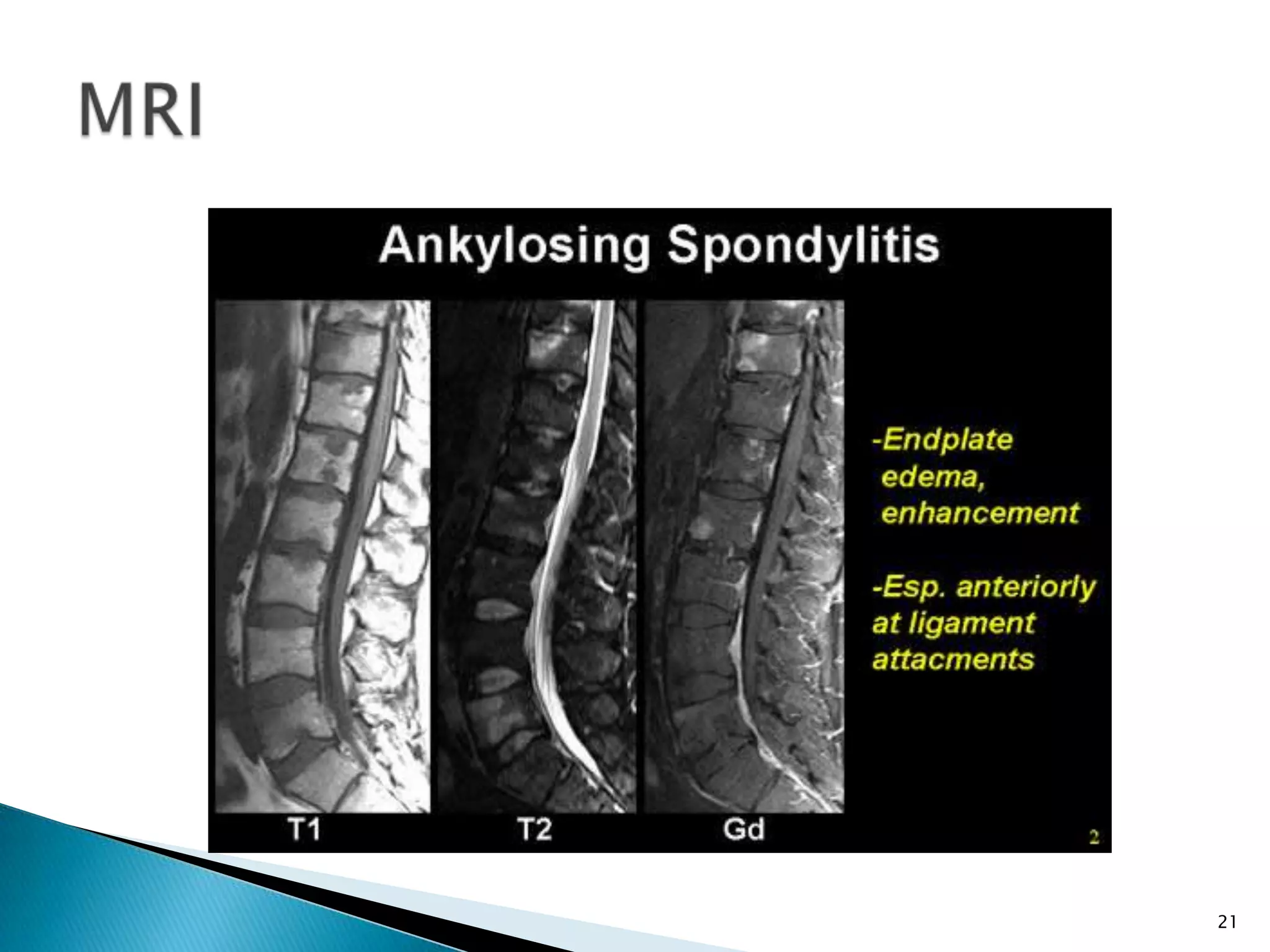 Ankylosing spondylitis management | PPTX