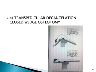 4) TRANSPEDICULAR DECANCELATION
CLOSED WEDGE OSTEOTOMY
3/13/2014
Free template from
www.brainybetty.com (copyright
2007) 46
 