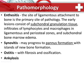 ProPowerPoint.Ru
Pathomorphology
• Enthesitis - the site of ligamentous attachment to
bone is the primary site of pathology. The early
lesions consist of subchondral granulation tissue,
infiltrates of lymphocytes and macrophages in
ligamentous and periosteal zones, and subchondral
bone marrow edema.
• Synovitis - may progress to pannus formation with
islands of new bone formation.
• Ostitis – with fibrosis and ossification.
• Ankylosis
 