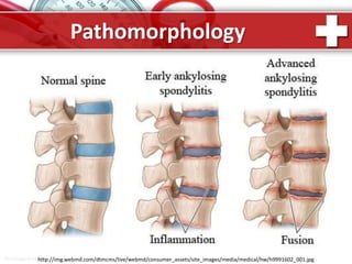 ProPowerPoint.Ru
Pathomorphology
http://img.webmd.com/dtmcms/live/webmd/consumer_assets/site_images/media/medical/hw/h9991602_001.jpg
 