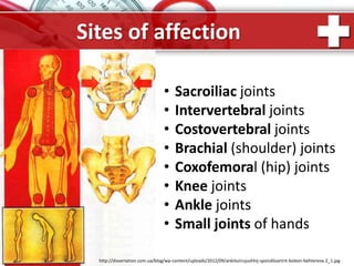 ProPowerPoint.Ru
Sites of affection
http://dissertation.com.ua/blog/wp-content/uploads/2012/09/ankilozirujushhij-spondiloartrit-bolezn-behtereva-2_1.jpg
• Sacroiliac joints
• Intervertebral joints
• Costovertebral joints
• Brachial (shoulder) joints
• Coxofemoral (hip) joints
• Knee joints
• Ankle joints
• Small joints of hands
 