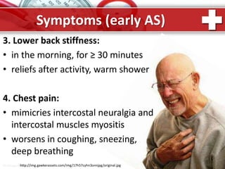 ProPowerPoint.Ru
Symptoms (early AS)
3. Lower back stiffness:
• in the morning, for ≥ 30 minutes
• reliefs after activity, warm shower
4. Chest pain:
• mimicries intercostal neuralgia and
intercostal muscles myositis
• worsens in coughing, sneezing,
deep breathing
http://img.gawkerassets.com/img/17h57cyhn3onnjpg/original.jpg
 