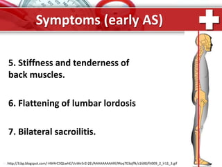 ProPowerPoint.Ru
Symptoms (early AS)
5. Stiffness and tenderness of
back muscles.
6. Flattening of lumbar lordosis
7. Bilateral sacroilitis.
http://3.bp.blogspot.com/-HM4rC3QLwhE/UuWv3rZr2EI/AAAAAAAAARI/MoqTE3ajffk/s1600/fit009_2_lr11_3.gif
 