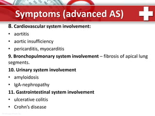 ProPowerPoint.Ru
Symptoms (advanced AS)
8. Cardiovascular system involvement:
• aortitis
• aortic insufficiency
• pericarditis, myocarditis
9. Bronchopulmonary system involvement – fibrosis of apical lung
segments.
10. Urinary system involvement
• amyloidosis
• IgA-nephropathy
11. Gastrointestinal system involvement
• ulcerative colitis
• Crohn’s disease
 