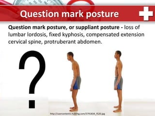 ProPowerPoint.Ru
Question mark posture
Question mark posture, or suppliant posture - loss of
lumbar lordosis, fixed kyphosis, compensated extension
cervical spine, protruberant abdomen.
http://usercontent1.hubimg.com/5791834_f520.jpg
 