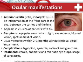 ProPowerPoint.Ru
Ocular manifestations
• Anterior uveitis (iritis, iridocyclitis) – is
an inflammation of the front part of the
eye, between the cornea and the lens.
• Appears in 20-30% of patients with AS.
http://zdorovyeglaza.ru/wp-content/uploads/2015/06/Problema-perednego-uveita-500x300.jpg
• Symptoms: eye pain, sensitivity to light, eye redness, blurred
vision, spots in field of vision.
• Usually resolves within 2–3 months without residual visual
impairment.
• Complications: hypopion, synechia, cataract and glaucoma.
• Treatment: steroid, antibiotic and midriatic eye drops, usage
of sunglasses.
 