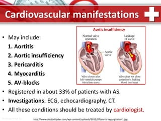 ProPowerPoint.Ru
Cardiovascular manifestations
• May include:
1. Aortitis
2. Aortic insufficiency
3. Pericarditis
4. Myocarditis
5. AV-blocks
• Registered in about 33% of patients with AS.
• Investigations: ECG, echocardiography, CT.
• All these conditions should be treated by cardiologist.
Aortic insufficiency
http://www.doctortipster.com/wp-content/uploads/2011/07/aortic-regurgitation1.jpg
 