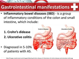 ProPowerPoint.Ru
Gastrointestinal manifestations
• Inflammatory bowel diseases (IBD) - is a group
of inflammatory conditions of the colon and small
intestine, which include:
1. Crohn’s didease
2. Ulcerative colitis
• Diagnosed in 5-10%
of patients with AS.
http://images.medicinenet.com/images/slideshow/crohns-disease-s5-illustration-of-crohns-disease-and-ulcerative-colitis.jpg
 