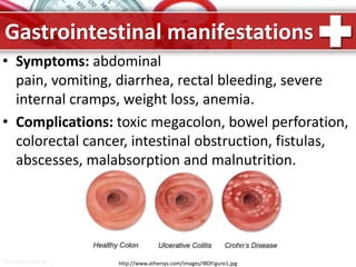 ProPowerPoint.Ru
• Symptoms: abdominal
pain, vomiting, diarrhea, rectal bleeding, severe
internal cramps, weight loss, anemia.
• Complications: toxic megacolon, bowel perforation,
colorectal cancer, intestinal obstruction, fistulas,
abscesses, malabsorption and malnutrition.
Gastrointestinal manifestations
http://www.athersys.com/images/IBDFigure1.jpg
 